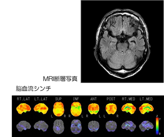 MRI断層写真・脳血流シンチ