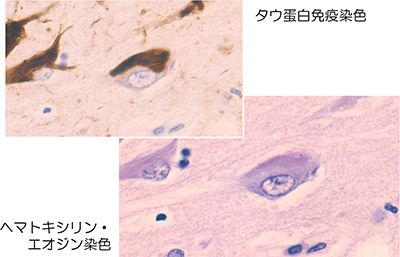 「神経原線維変化（NFT）」の顕微鏡写真