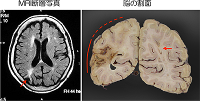 MRI断層写真と剖検脳の割面